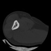 SPORK, NICO - 22.03.1976 - 02.08.2022 - CT obere Extremität - 17:59:38